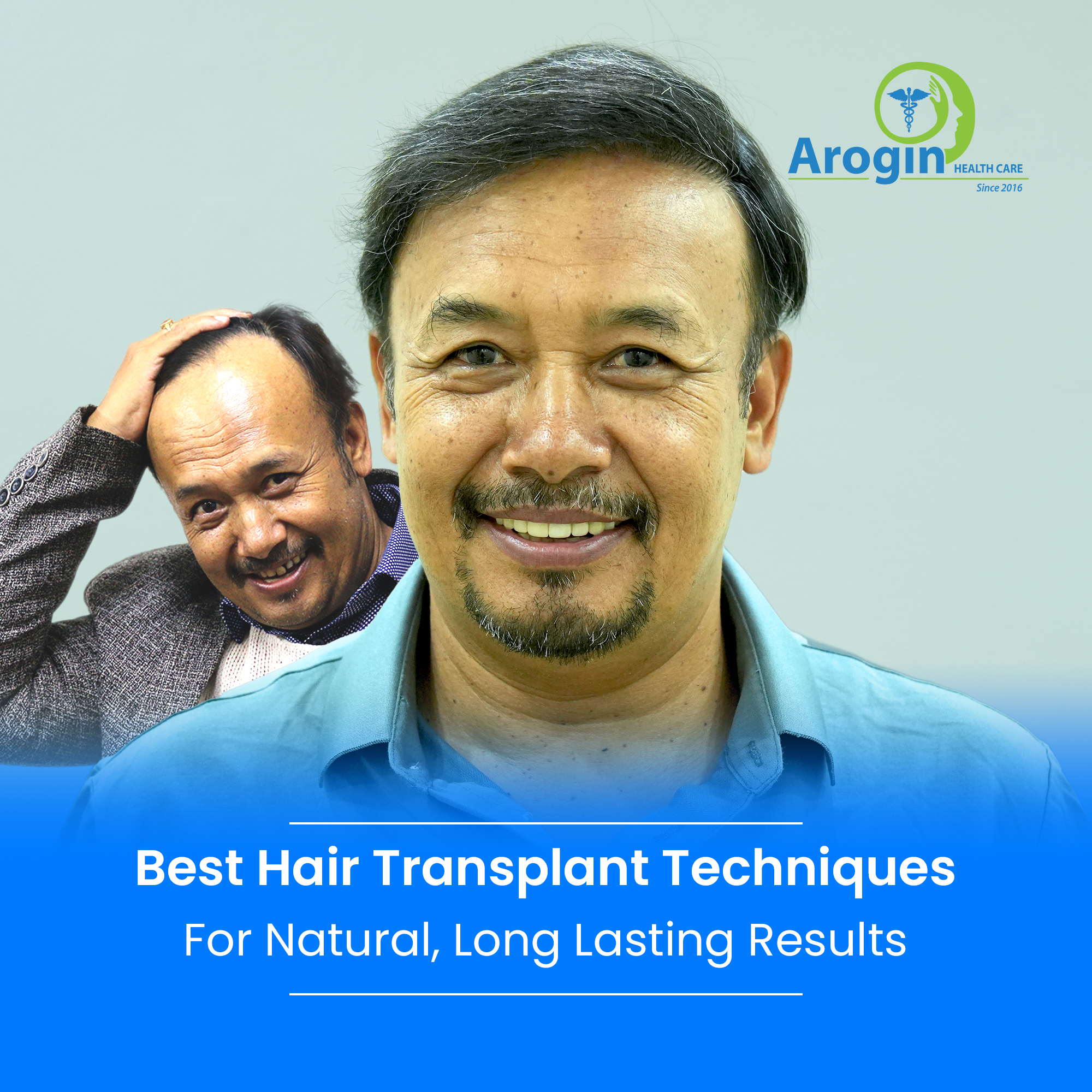 Best Hair Transplant Techniques for Natural, Long Lasting Results